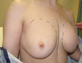 Before Image: Breast Augmentation - right-front-oblique