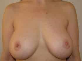 After Image: Breast Augmentation - front