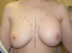 Before Image: Breast Augmentation - front