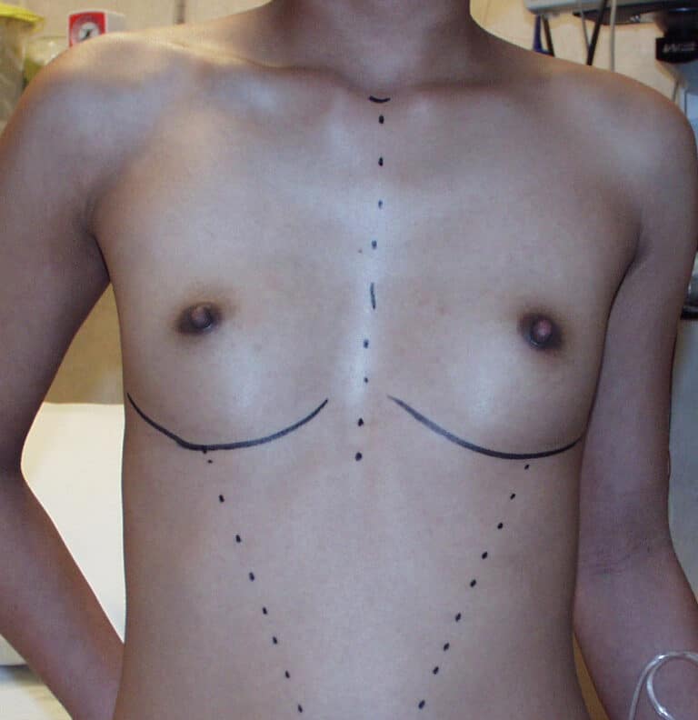 Before Image: Breast Augmentation - front