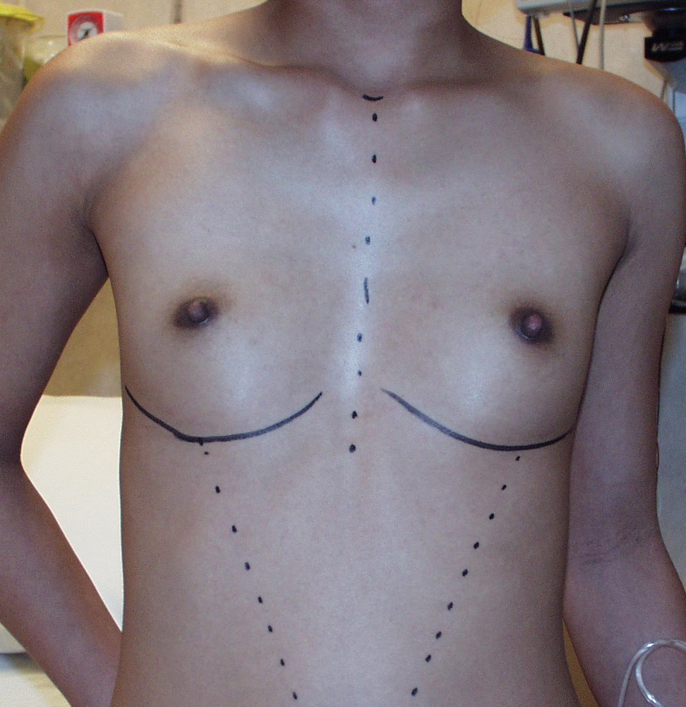 Before Image: Breast Augmentation - front