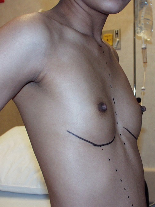 Before Image: Breast Augmentation - right-front-oblique