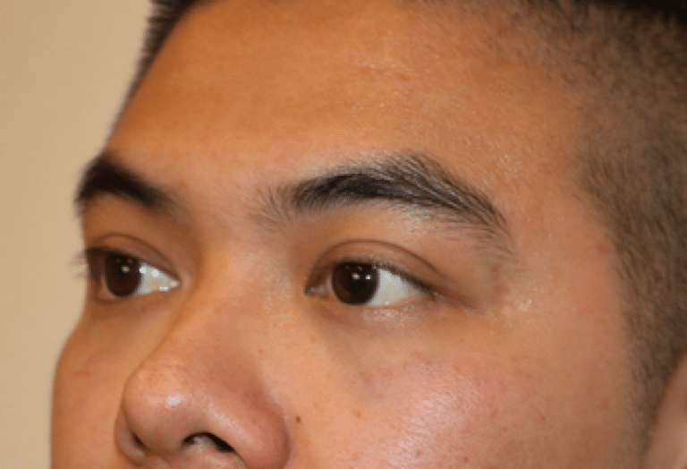 After Image: Belotero - left-front-oblique