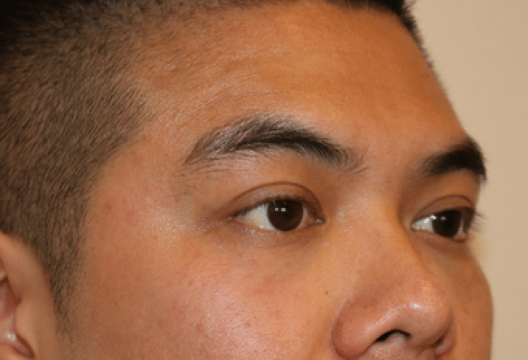 After Image: Belotero - right-front-oblique