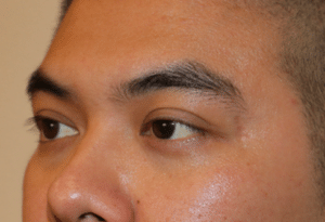 Before Image: Belotero