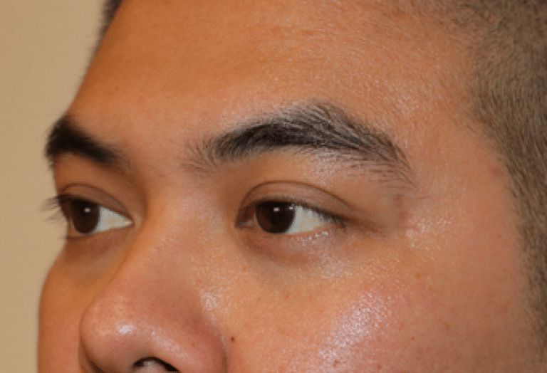 Before Image: Belotero - left-front-oblique