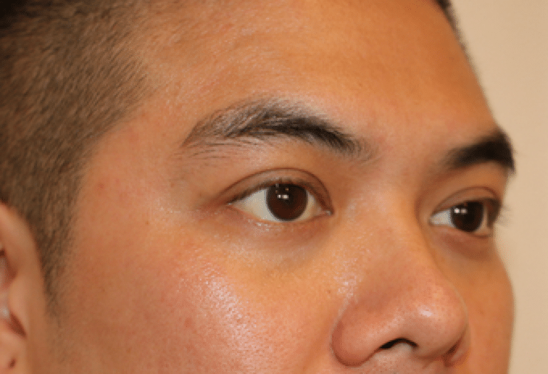 Before Image: Belotero - right-front-oblique