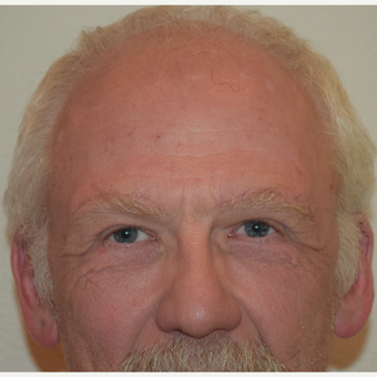 After Image: Brow Lift - front