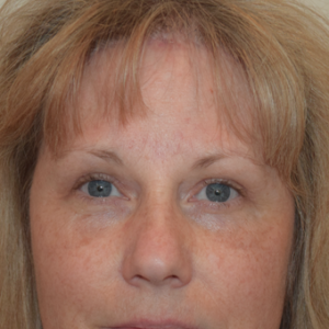 After Image: Brow Lift