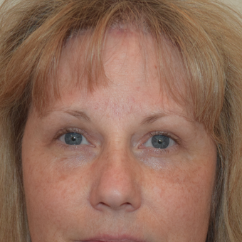 After Image: Brow Lift - front