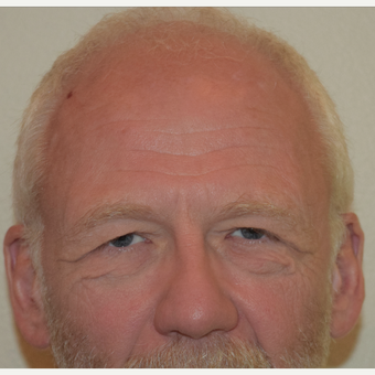 Before Image: Brow Lift - front