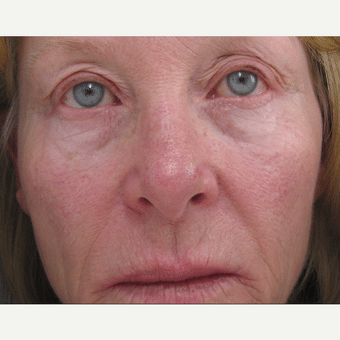 Before Image: CO2 Laser - front