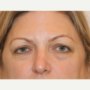 Before Image: CO2 Laser