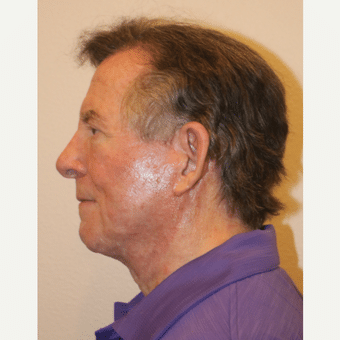 After Image: Chin Implant - left-side