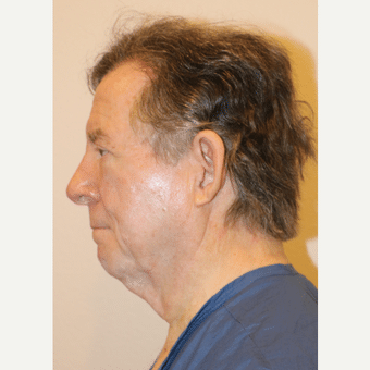 Before Image: Chin Implant - left-side