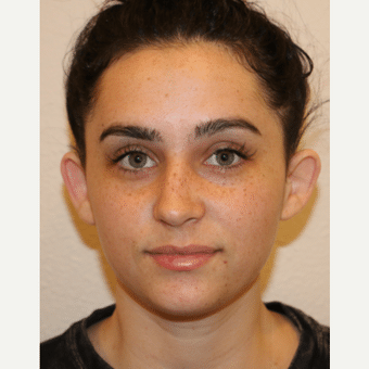 Before Image: Ear Surgery - front