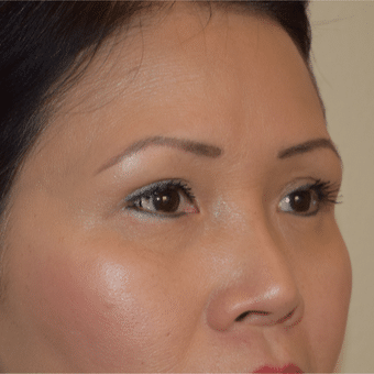 After Image: Eyelid Surgery - right-front-oblique