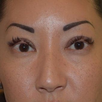 After Image: Eyelid Surgery - front