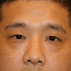Before Image: Eyelid Surgery