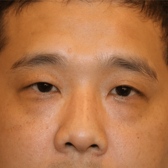 Before Image: Eyelid Surgery - front