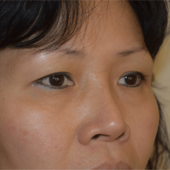 Before Image: Eyelid Surgery - right-front-oblique