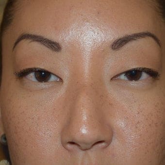 Before Image: Eyelid Surgery - front