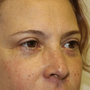 After Image: Eye Bags Treatment