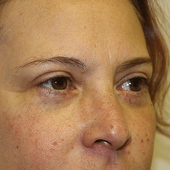 After Image: Eye Bags Treatment - right-front-oblique