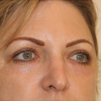 After Image: Eye Bags Treatment - right-front-oblique