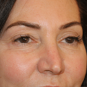 Before Image: Eye Bags Treatment
