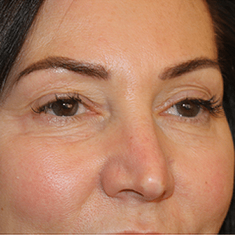 Before Image: Eye Bags Treatment - right-front-oblique
