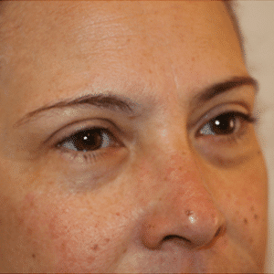 Before Image: Eye Bags Treatment