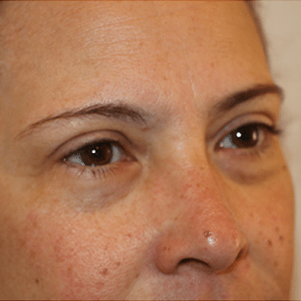 Before Image: Eye Bags Treatment - right-front-oblique