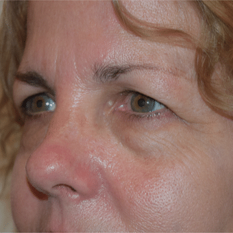 Before Image: Eye Bags Treatment - left-front-oblique