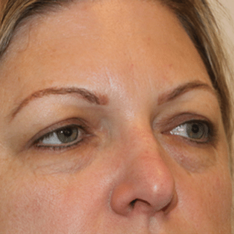 Before Image: Eye Bags Treatment - right-front-oblique