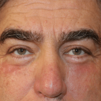 After Image: Eyelid Surgery - front
