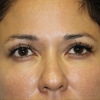 After Image: Eyelid Surgery - front