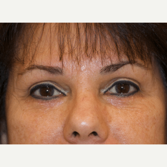 After Image: Eyelid Surgery - front