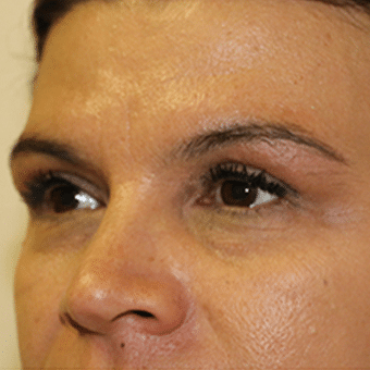 After Image: Eyelid Surgery - left-front-oblique