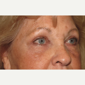 After Image: Eyelid Surgery - right-front-oblique