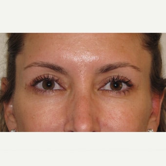 After Image: Eyelid Surgery - front