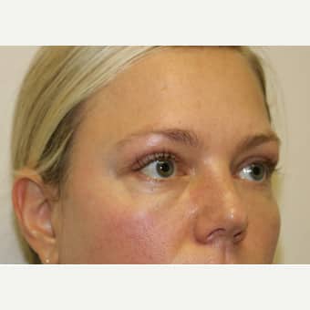After Image: Eyelid Surgery - right-front-oblique