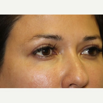 After Image: Eyelid Surgery - right-front-oblique