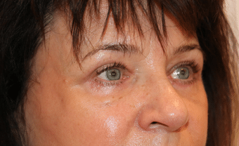 After Image: Eyelid Surgery - right-front-oblique