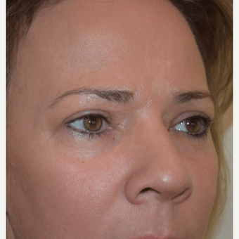 After Image: Eyelid Surgery - right-front-oblique