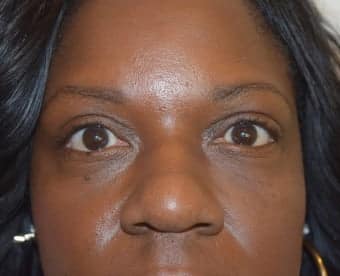After Image: Eyelid Surgery - front