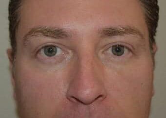 After Image: Eyelid Surgery - front