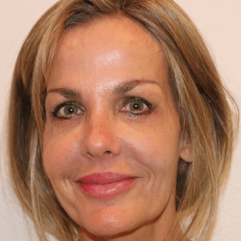 After Image: Eyelid Surgery - front