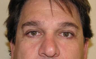 After Image: Eyelid Surgery - front