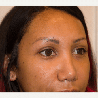 After Image: Eyelid Surgery - right-front-oblique